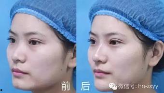 微整形网红套餐图片,美丽背后的真相与风险